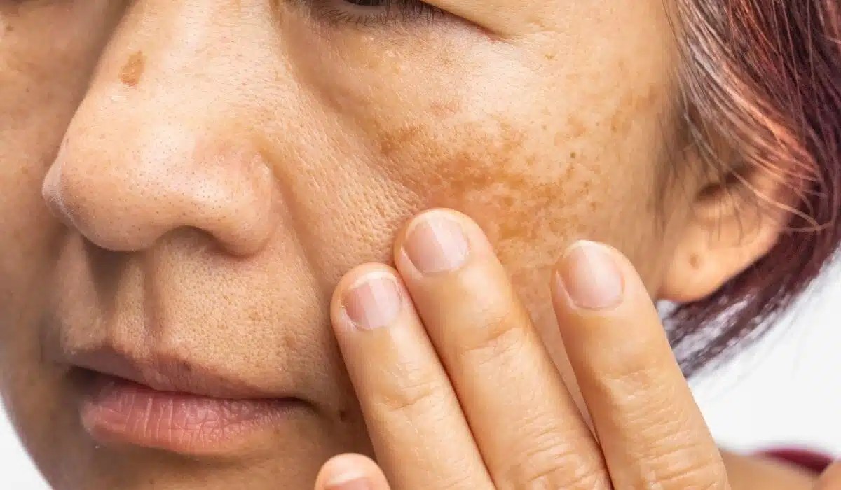 Descubre cómo diferenciar manchas y lunares en la cara | Multilaser