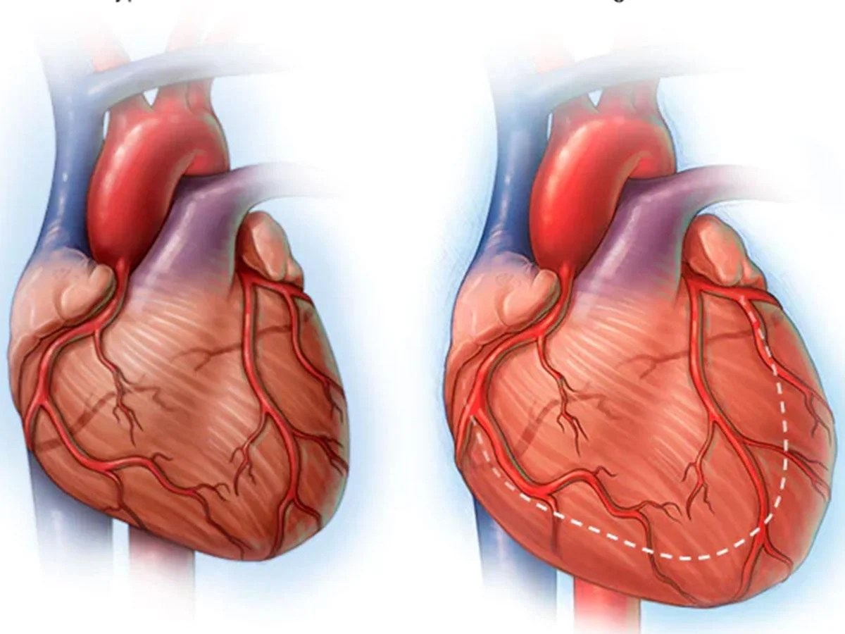 Pembengkakan jantung karena apa